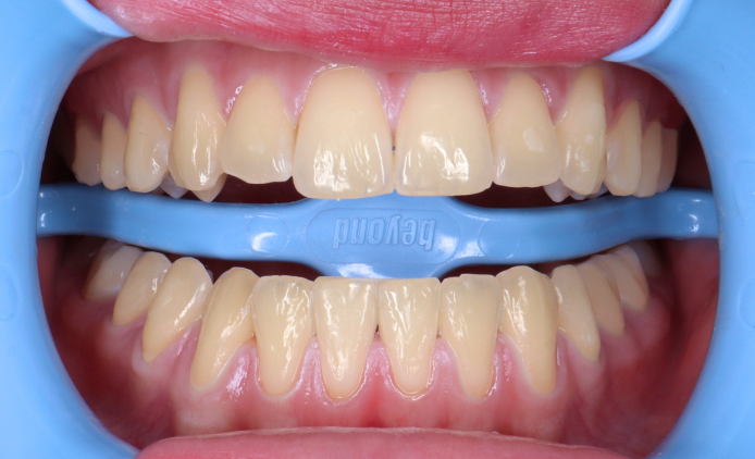 Dentadura antes del tratamiento