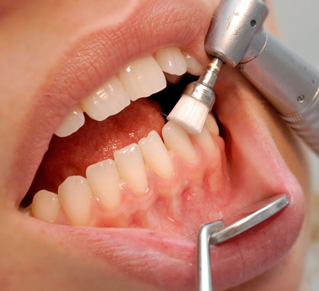 Regeneración Tisular en Periodoncia: Nuevas Fronteras