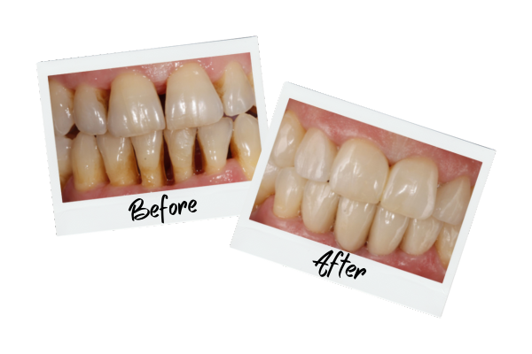 Periodoncia